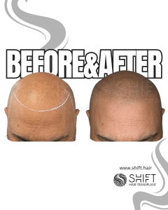 Scalp Micropigmentation for the Shaved Look Turkey Before After SHIFT Hair Transplant in Istanbul 50 3
