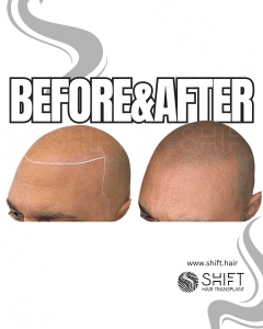 Scalp Micropigmentation for the Shaved Look Turkey Before After SHIFT Hair Transplant in Istanbul 52 3