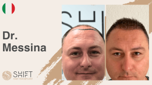 Una miniatura de un testimonio en vídeo sobre trasplante capilar en SHIFT Hair en Turquía realizado por el Dr Messina