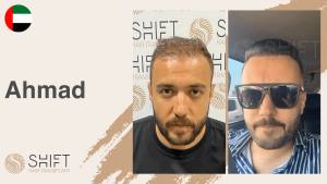 Una miniatura de un testimonio en vídeo sobre trasplante capilar en SHIFT Hair en Turquía realizado por el Sr Ahmad