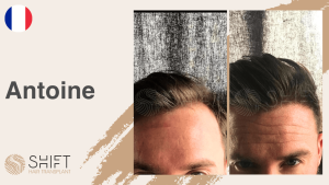 Una miniatura de un testimonio en vídeo sobre trasplante capilar en SHIFT Hair en Turquía realizado por el Sr Antoine