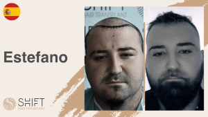 Una miniatura de un testimonio en vídeo sobre trasplante capilar en SHIFT Hair en Turquía realizado por el Sr Estefano