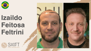 Una miniatura de un testimonio en vídeo sobre trasplante capilar en SHIFT Hair en Turquía realizado por el Sr Izaildo Feitosa Feltrini
