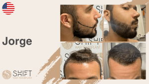 Una miniatura de un testimonio en vídeo sobre trasplante capilar en SHIFT Hair en Turquía realizado por el Sr Jorge