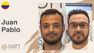 Una miniatura de un testimonio en vídeo sobre trasplante capilar en SHIFT Hair en Turquía realizado por el Sr Juan Pablo