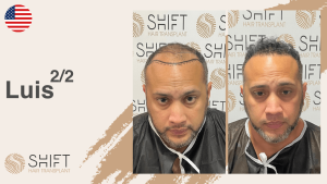 Una miniatura de un testimonio en vídeo sobre trasplante capilar en SHIFT Hair en Turquía realizado por el Sr Luis 2