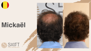 Una miniatura de un testimonio en vídeo sobre trasplante capilar en SHIFT Hair en Turquía realizado por el Sr Mickaël