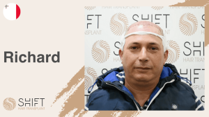 Una miniatura de un testimonio en vídeo sobre trasplante capilar en SHIFT Hair en Turquía realizado por el Sr Richard
