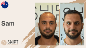 Una miniatura de un testimonio en vídeo sobre trasplante capilar en SHIFT Hair en Turquía realizado por el Sr Sam