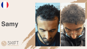 Una miniatura de un testimonio en vídeo sobre trasplante capilar en SHIFT Hair en Turquía realizado por el Sr Samy