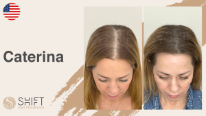 Una miniatura de un video testimonial sobre micropigmentación del cuero cabelludo en SHIFT Hair en Turquía por el Sra Caterina