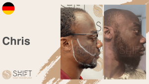 Una miniatura de un video testimonial sobre trasplante de barba afro en SHIFT Hair en Turquía realizado por el Sr Chris 3