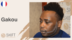 Una miniatura de un video testimonial sobre trasplante de barba afro en SHIFT Hair en Turquía realizado por el Sr Gakou