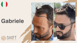 Una miniatura de un video testimonial sobre trasplante de barba en SHIFT Hair en Turquía realizado por el Sr Gabriele