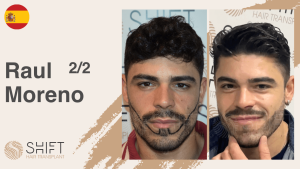 Una miniatura de un video testimonial sobre trasplante de barba en SHIFT Hair en Turquía realizado por el Sr Raul Moreno 2