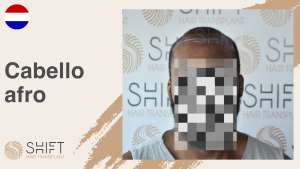 Una miniatura de un video testimonial sobre trasplante de cabello afro en SHIFT Hair en Turquía