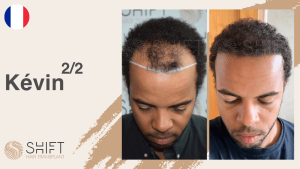 Una miniatura de un video testimonial sobre trasplante de cabello afro en SHIFT Hair en Turquía realizado por el Sr Kévin 2