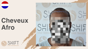 Une vignette d'un témoignage vidéo de greffe de cheveux afro chez SHIFT Hair en Turquie