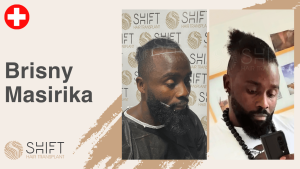 Une vignette d'un témoignage vidéo de greffe de cheveux afro chez SHIFT Hair en Turquie par M Brisny Masirika