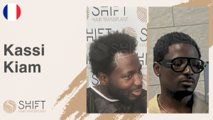 Une vignette d'un témoignage vidéo de greffe de cheveux afro chez SHIFT Hair en Turquie par M Kassi Kiam