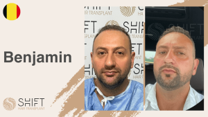 Une vignette d'un témoignage vidéo sur la greffe de cheveux chez SHIFT Hair en Turquie par M Benjamin
