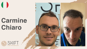 Une vignette d'un témoignage vidéo sur la greffe de cheveux chez SHIFT Hair en Turquie par M Carmine Chiaro