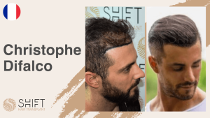 Une vignette d'un témoignage vidéo sur la greffe de cheveux chez SHIFT Hair en Turquie par M Christophe Difalco