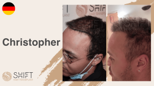 Une vignette d'un témoignage vidéo sur la greffe de cheveux chez SHIFT Hair en Turquie par M Christopher