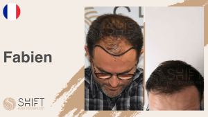 Une vignette d'un témoignage vidéo sur la greffe de cheveux chez SHIFT Hair en Turquie par M Fabien