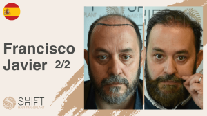 Une vignette d'un témoignage vidéo sur la greffe de cheveux chez SHIFT Hair en Turquie par M Francisco Javier 2