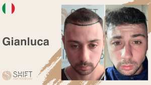 Une vignette d'un témoignage vidéo sur la greffe de cheveux chez SHIFT Hair en Turquie par M Gianluca