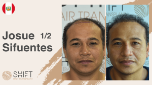 Une vignette d'un témoignage vidéo sur la greffe de cheveux chez SHIFT Hair en Turquie par M Josue Sifuentes 1