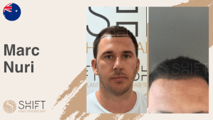 Une vignette d'un témoignage vidéo sur la greffe de cheveux chez SHIFT Hair en Turquie par M Marc Nuri