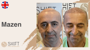 Une vignette d'un témoignage vidéo sur la micropigmentation du cuir chevelu chez SHIFT Hair en Turquie par M Mazen