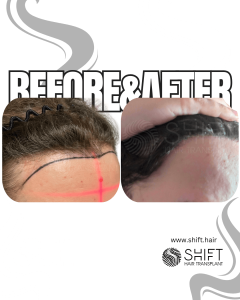 Women Hair Transplant Turkey Before After SHIFT Hair Transplant in Istanbul 14 3