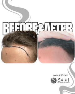 Women Hair Transplant Turkey Before After SHIFT Hair Transplant in Istanbul 15 3