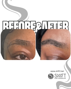 Afro Eyebrow Transplant Turkey Before After SHIFT Hair Transplant in Istanbul 03 3