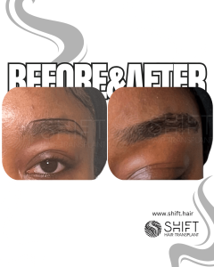 Afro Eyebrow Transplant Turkey Before After SHIFT Hair Transplant in Istanbul 04 3
