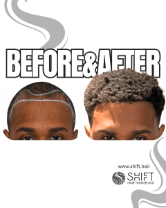 Afro Hair Transplant Turkey Before After SHIFT Hair Transplant in Istanbul 45 3