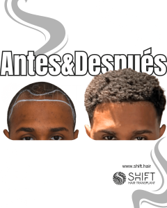 Antes Después de un trasplante de cabello afro en Turquía en SHIFT Hair en Estambul 45 3