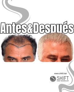 Antes y después de un trasplante capilar para la calvicie de Norwood 6 en Turquía en SHIFT Hair en Estambul 21 3