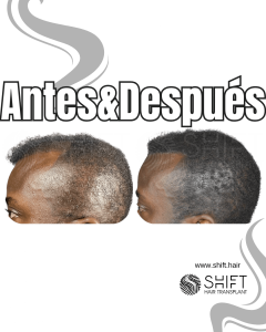 Antes y después de una micropigmentación capilar para un camuflaje de densidad en Turquía en SHIFT Hair en Estambul 100 3