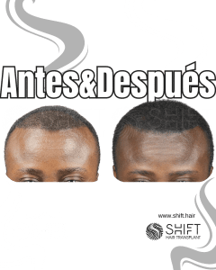Antes y después de una micropigmentación capilar para un camuflaje de densidad en Turquía en SHIFT Hair en Estambul 97 3
