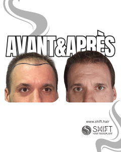 Avant Après de Greffe de Cheveux pour Calvitie Norwood 4 en Turquie chez SHIFT Hair à Istanbul 27 3