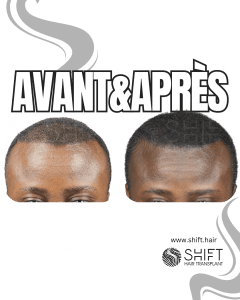 Avant Après de la micropigmentation du cuir chevelu pour le camouflage de densité en Turquie chez SHIFT Hair à Istanbul 97 3
