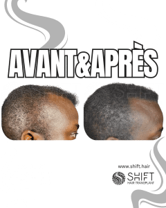 Avant Après de la micropigmentation du cuir chevelu pour le camouflage de densité en Turquie chez SHIFT Hair à Istanbul 99 3