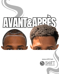 Avant Après une greffe de cheveux afro en Turquie chez SHIFT Hair à Istanbul 45 3