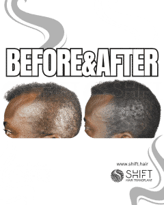 Scalp Micropigmentation for Density Camouflage Turkey Before After SHIFT Hair Transplant in Istanbul 100 3