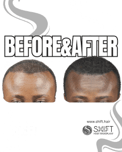 Scalp Micropigmentation for Density Camouflage Turkey Before After SHIFT Hair Transplant in Istanbul 97 3