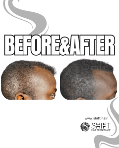 Scalp Micropigmentation for Density Camouflage Turkey Before After SHIFT Hair Transplant in Istanbul 99 3